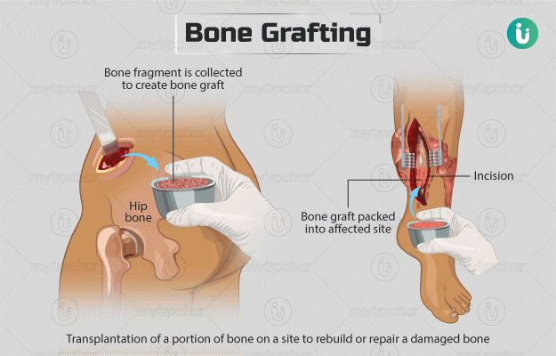 BONE GRAFTING