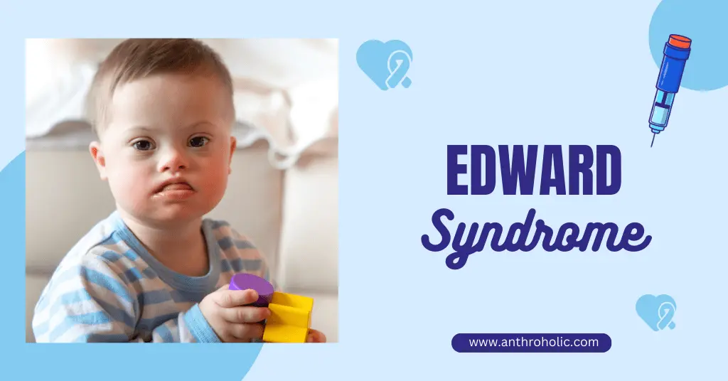 EDWARDS SYNDROME