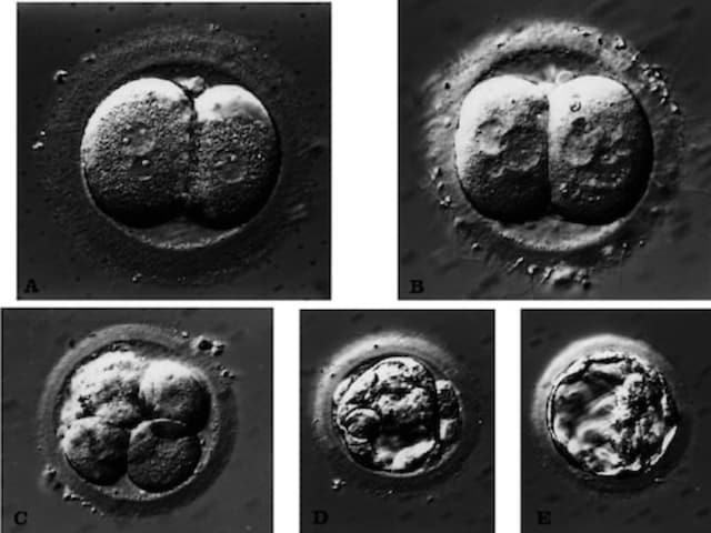 Impact of US Court judgement on IVF