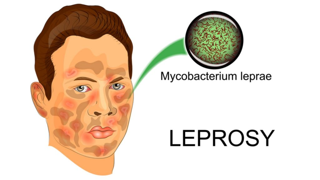 LEPROSY