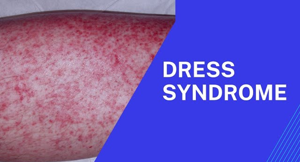 IPC alerted about DRESS Syndrome UPSC